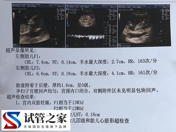 移植21天为什么要做B超