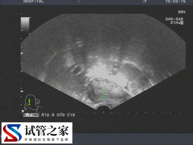 宫颈肥大做试管婴儿会不会影响着床(图1)