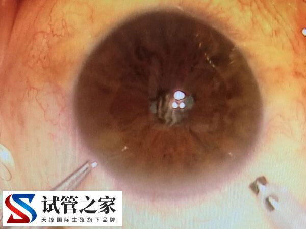 角膜营养不良有无必要做三代试管避免遗传(图1)