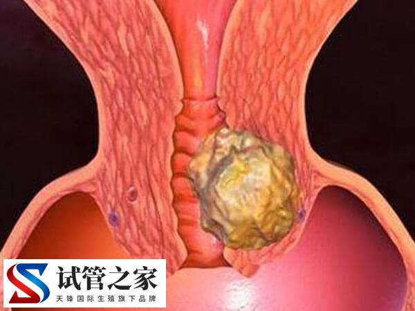 内膜癌逆转后对试管有没有影响(图1)