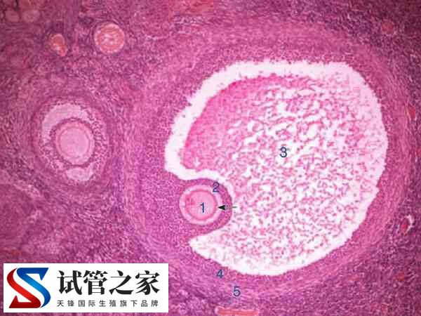 试管婴儿出现多精入卵怎么办(图2)