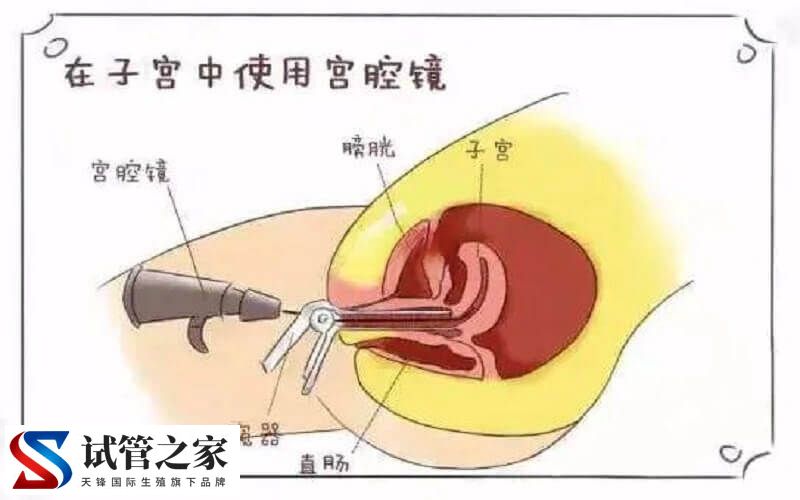 做宫腔镜检查痛不痛(图1)