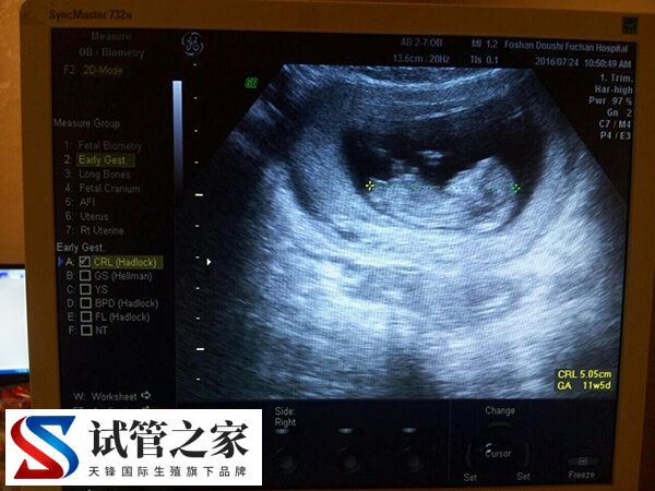 孕早期阴道B超有没有必要做(图2)