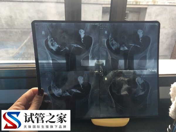 女性输卵管不孕治疗方式有哪些(图1) 女性输卵管不孕治疗方式有哪些(图1)