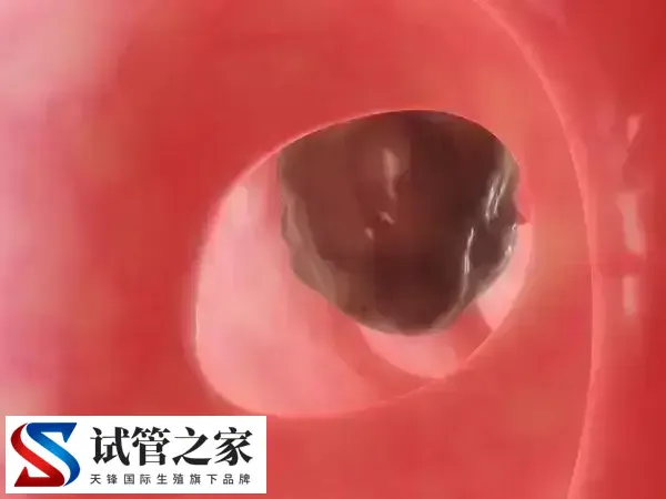 子宫内膜异位能不能做试管