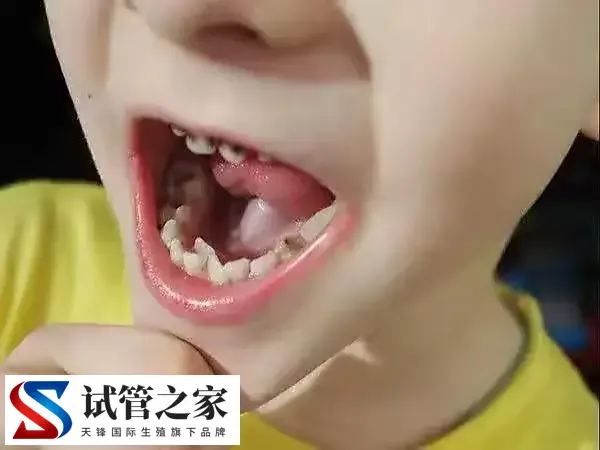 宝宝出牙晚是什么原因导致的(图1) 宝宝出牙晚是什么原因导致的(图1)