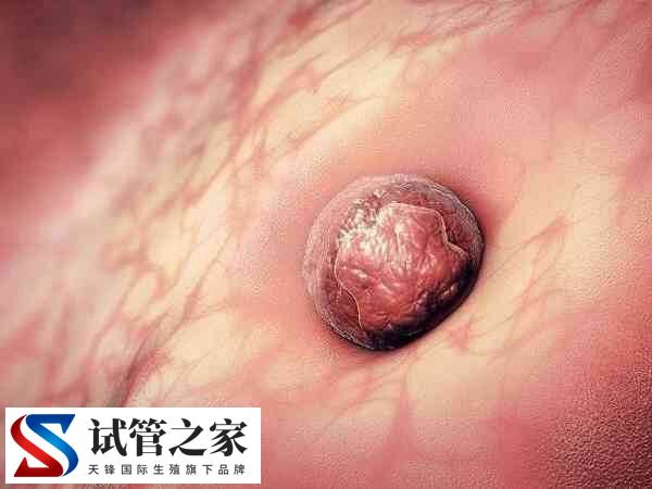 子宫内膜活跃对胚胎着床好不好(图1) 子宫内膜活跃对胚胎着床好不好(图1)