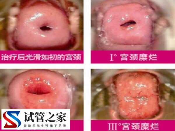 宫颈糜烂一二三度图片什么样(图1) 宫颈糜烂一二三度图片什么样(图1)