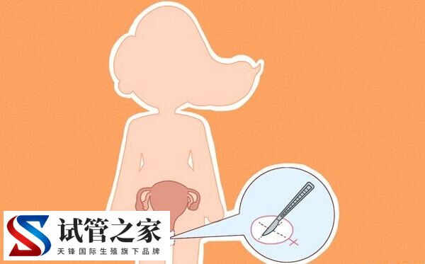 始基子宫怎么治疗(图4)
