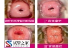 宫颈糜烂一二三度图片什么样